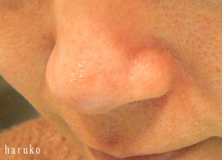 ６日目 鼻の頭の皮がむけてる 洗顔で乾燥肌を治す